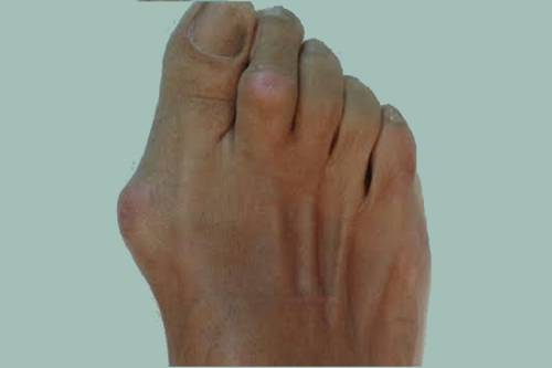 Hallux valgus