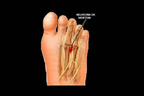 Neuroma de Morton