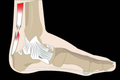 Rotura Tendon Aquiles