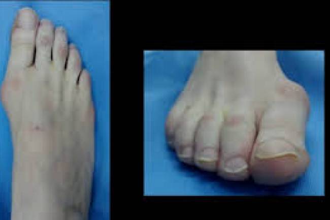 cirugia de pies juanetes