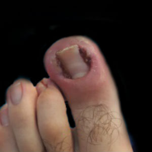 Dolor de pie Infecciones y Tumores